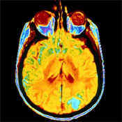 Proving Traumatic Brain Injury